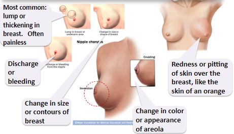 Breast Cancer Symptoms